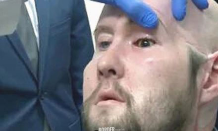 Hito científico: realizaron el primer trasplante de ojo completo